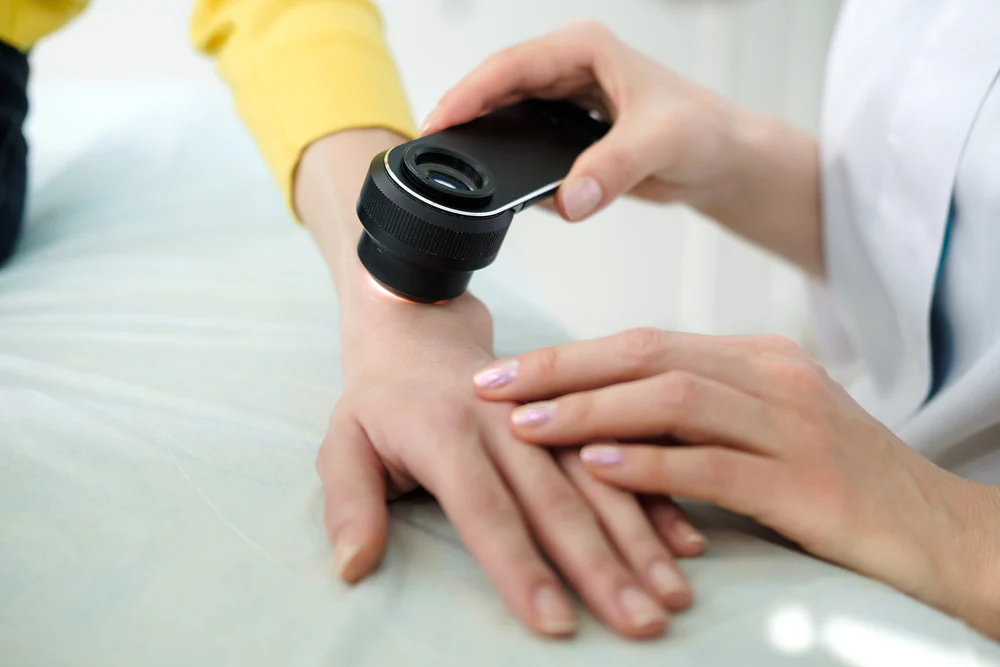 dermoscopy mole check cambridge.